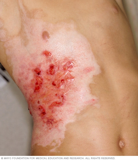 Quemadura de tercer grado