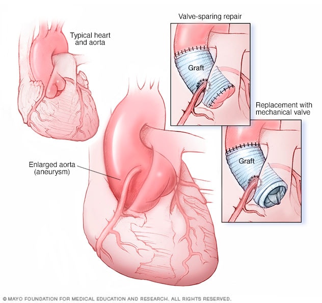 Ascending aortic root aneurysm repair and replacement