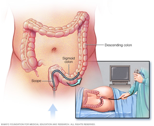 Flexible sigmoidoscopy