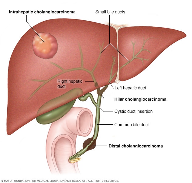 أماكن حدوث سرطان الأقنية الصفراوية.